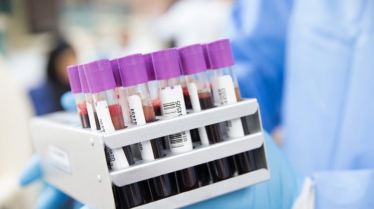 A rák több mint 50 típusát mutatja ki egy új vérvizsgálat